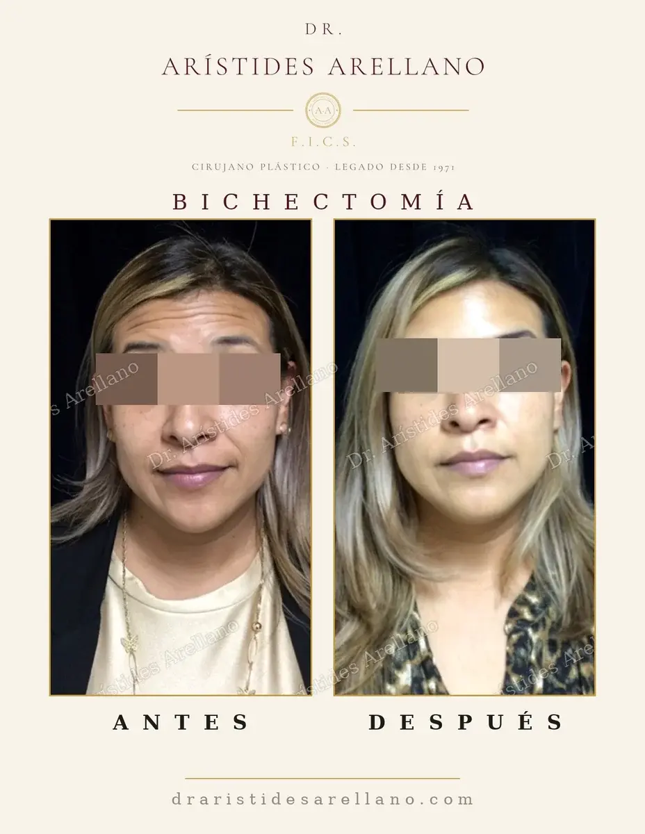 Antes y después de bichectomía: caso real del Dr. Arístides Arellano (2 de 4)