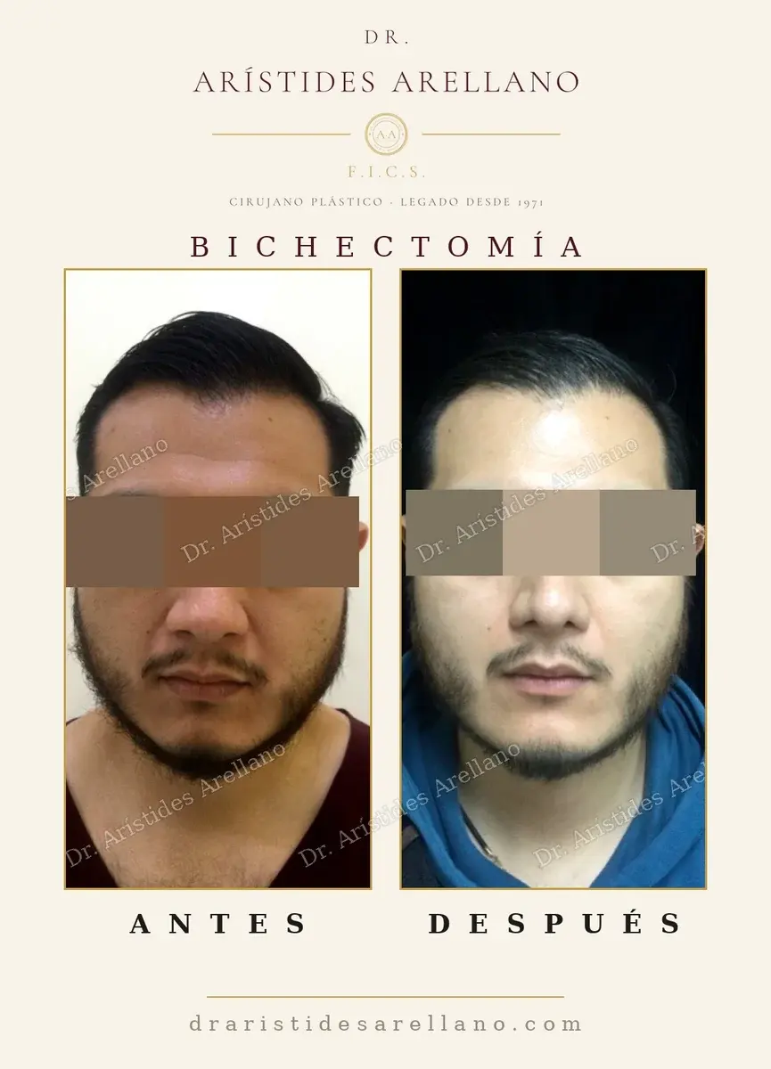 Antes y después de bichectomía: caso real del Dr. Arístides Arellano (3 de 4)