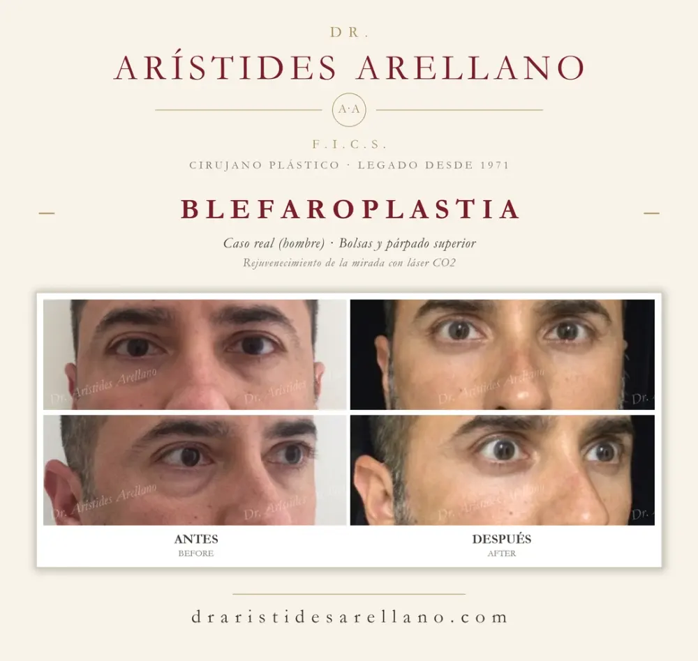 Antes y después de blefaroplastia: caso real del Dr. Arístides Arellano (3 de 4)