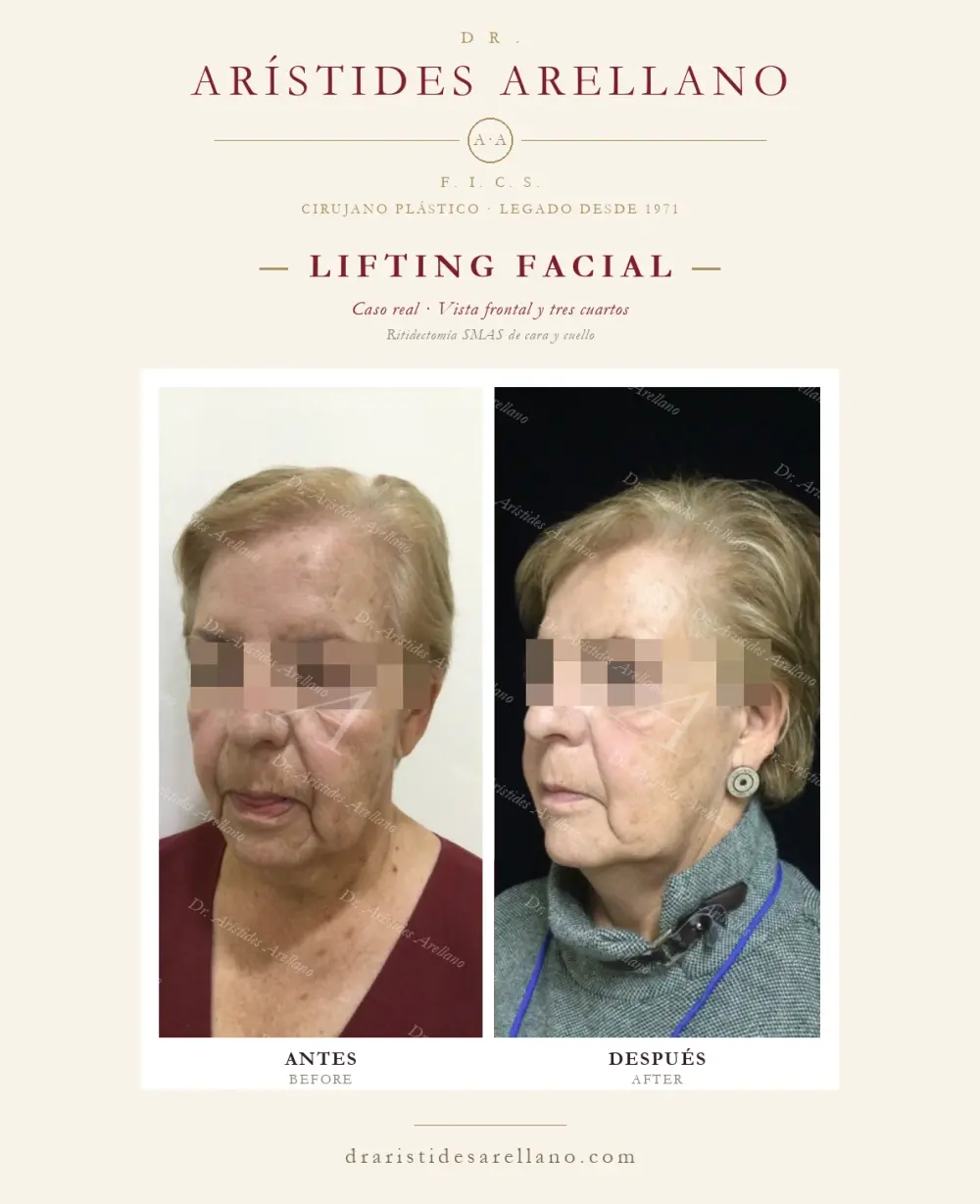 Antes y después de lifting facial: caso real del Dr. Arístides Arellano (1 de 4)
