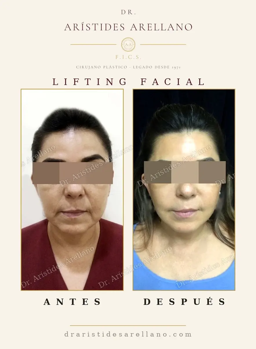 Antes y después de lifting facial: caso real del Dr. Arístides Arellano (3 de 4)