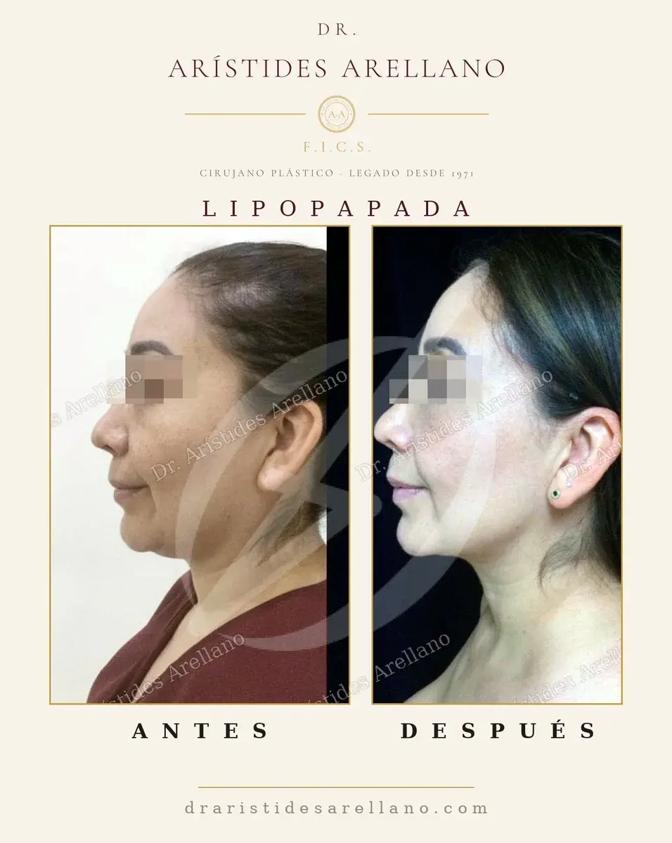 Antes y después de lipopapada: caso real del Dr. Arístides Arellano (1 de 4)