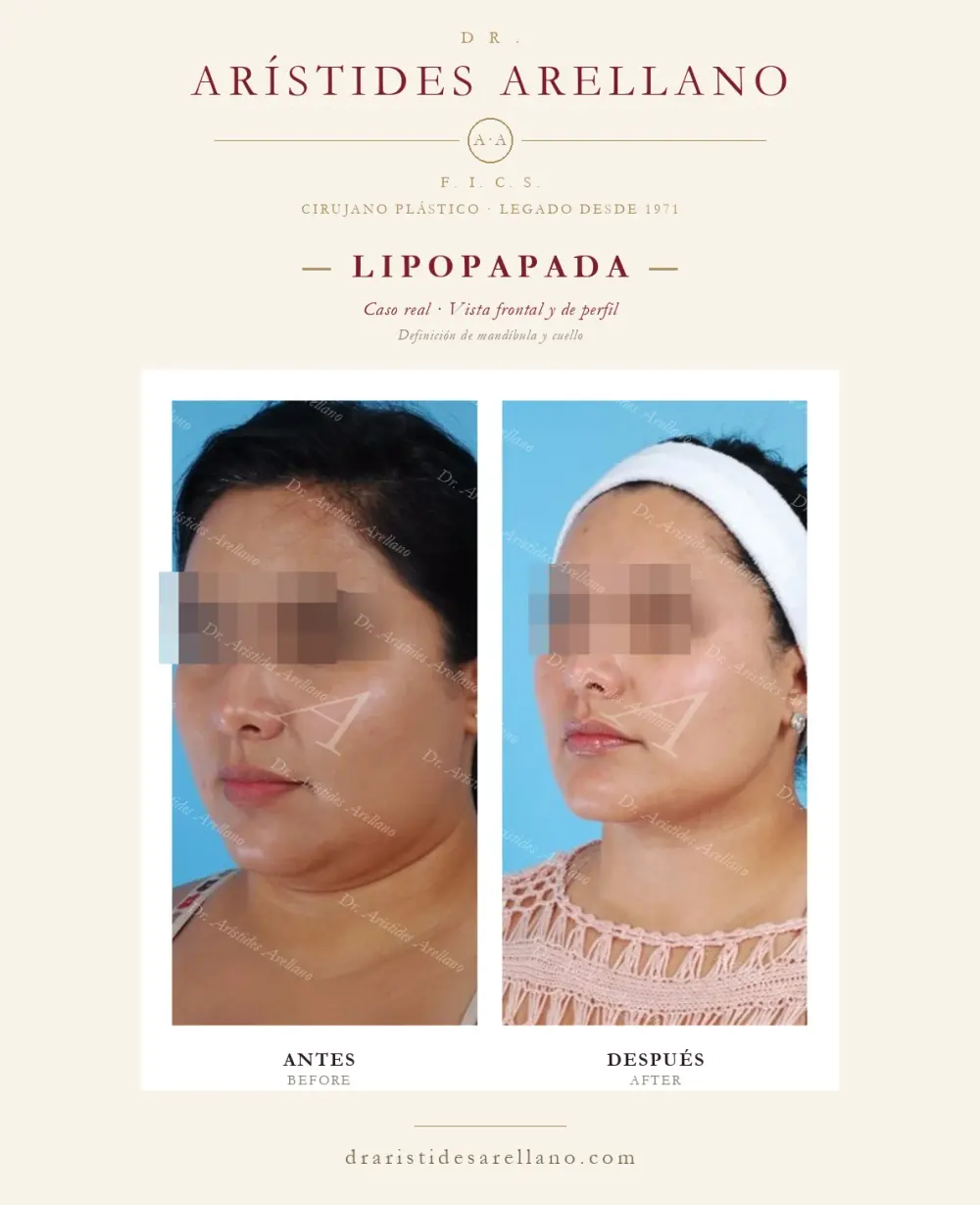Antes y después de lipopapada: caso real del Dr. Arístides Arellano (2 de 4)
