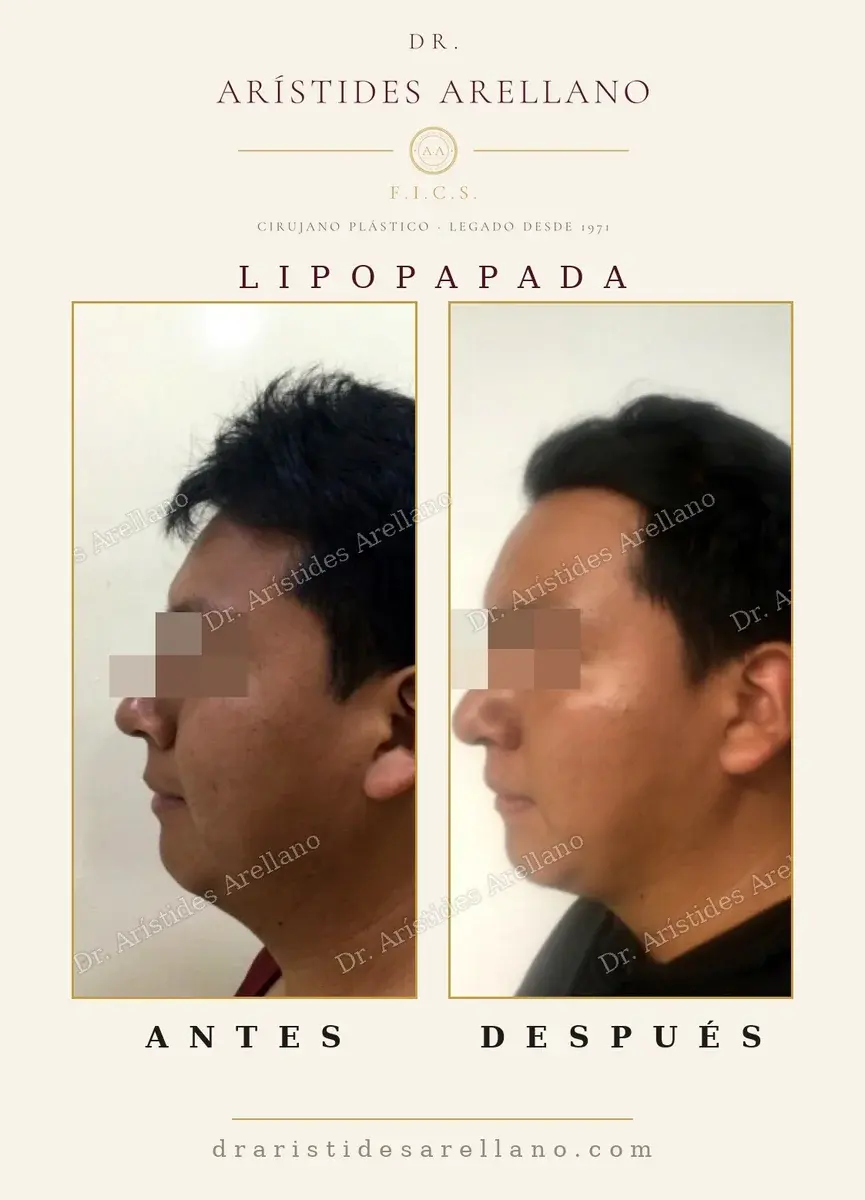 Antes y después de lipopapada: caso real del Dr. Arístides Arellano (4 de 4)