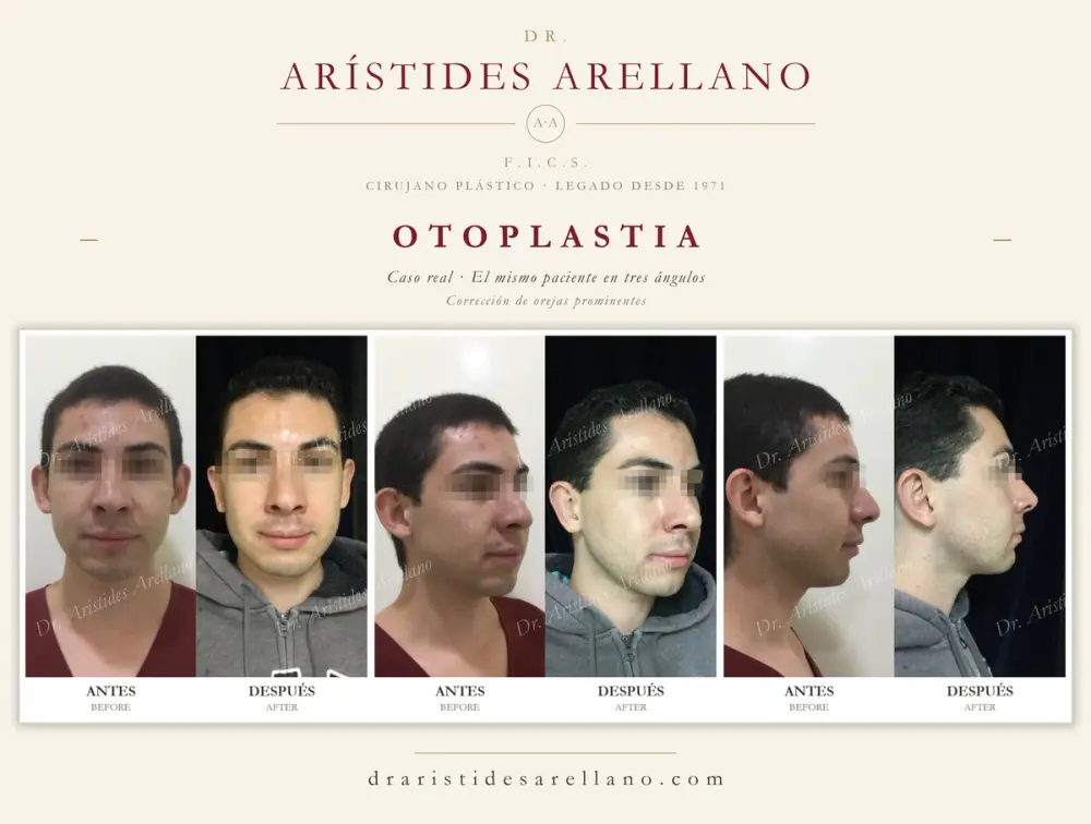 Antes y después de otoplastia: caso real del Dr. Arístides Arellano (1 de 2)