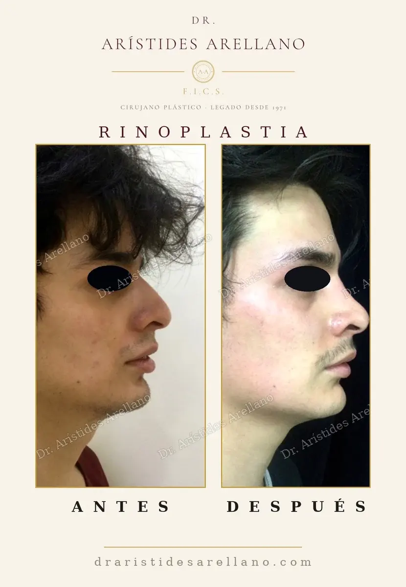 Antes y después de rinoplastia: caso real del Dr. Arístides Arellano (4 de 4)